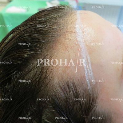 Slider image (1) Prohair Klinika Budapest